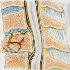 Fratura da coluna vertebral