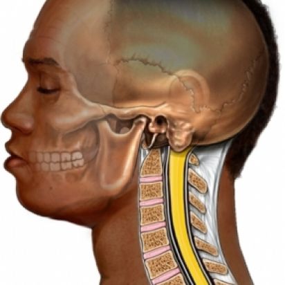 Mielopatia Cervical