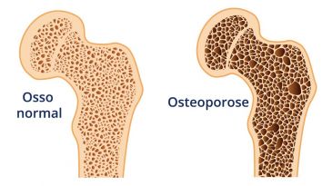  10 Coisas que Voc Precisa Saber Sobre a Osteoporose 